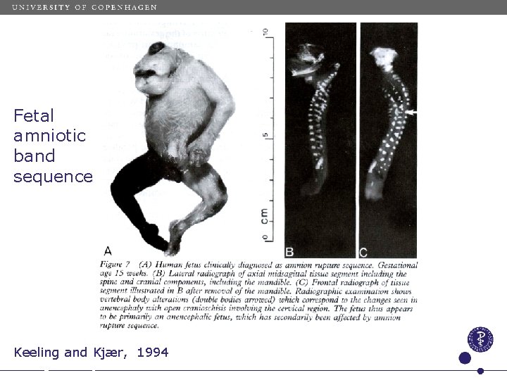 Fetal amniotic band sequence Keeling and Kjær, 1994 