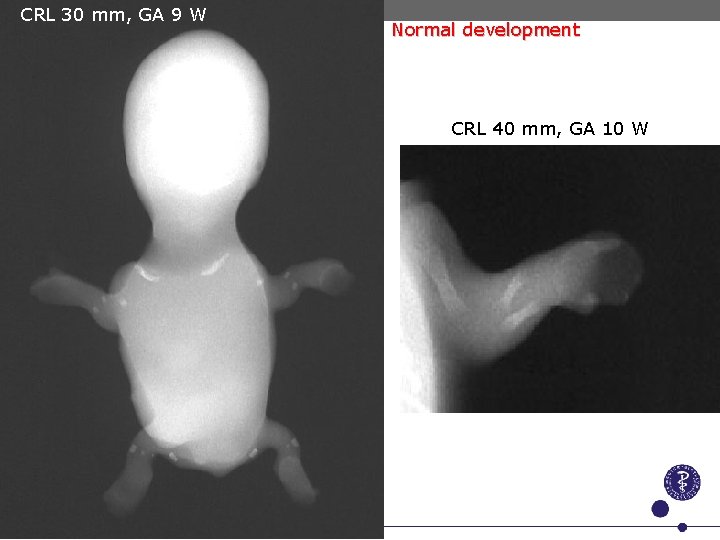 CRL 30 mm, GA 9 W Normal development CRL 40 mm, GA 10 W