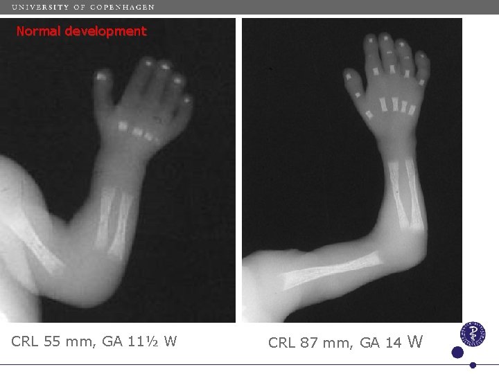 Normal development CRL 55 mm, GA 11½ W CRL 87 mm, GA 14 W