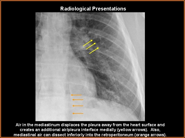 Radiological Presentations Air in the mediastinum displaces the pleura away from the heart surface