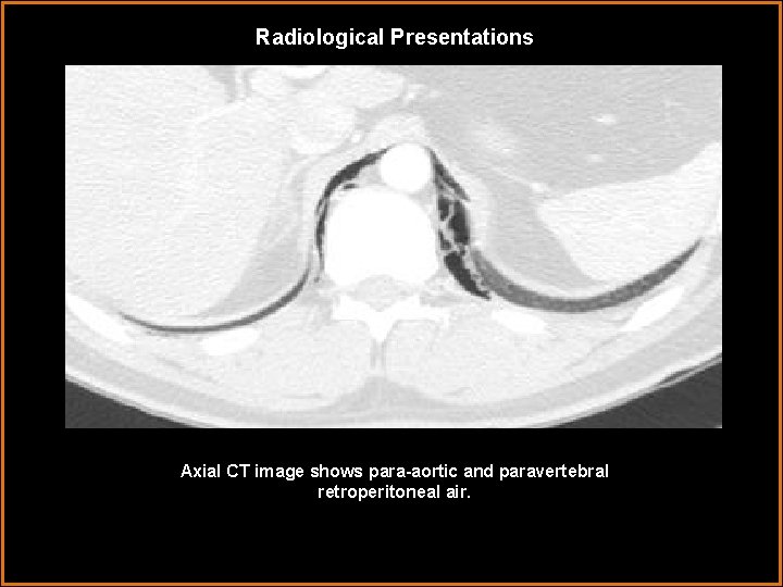 Radiological Presentations Axial CT image shows para-aortic and paravertebral retroperitoneal air. 