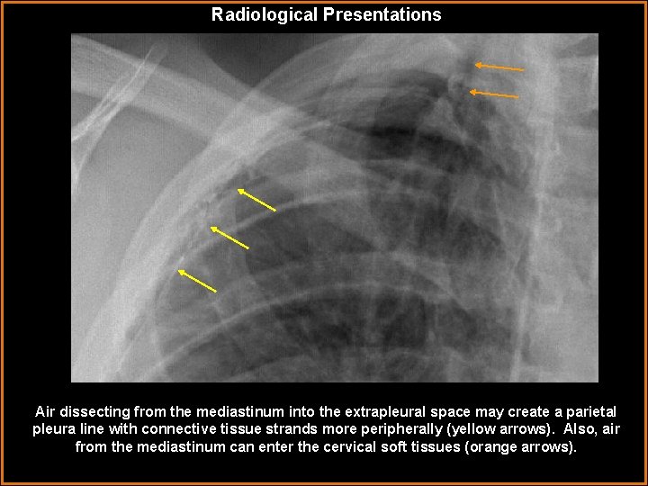 Radiological Presentations Air dissecting from the mediastinum into the extrapleural space may create a