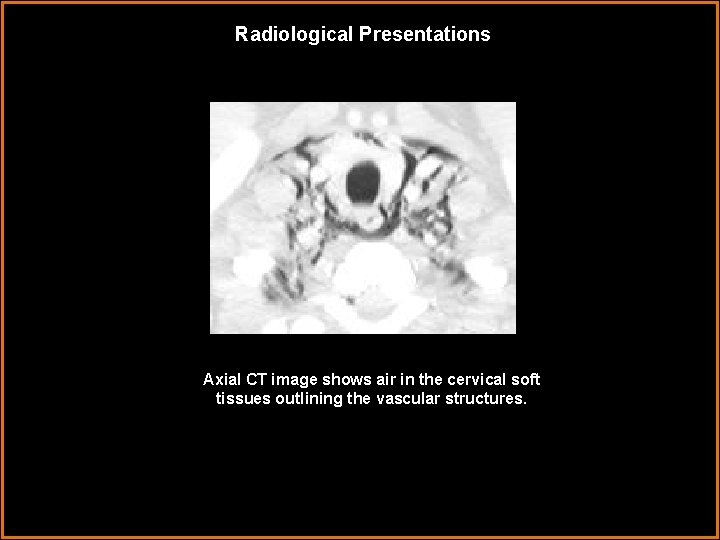 Radiological Presentations Axial CT image shows air in the cervical soft tissues outlining the