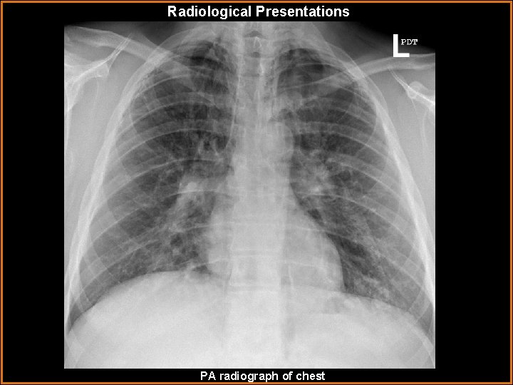 Radiological Presentations PA radiograph of chest 