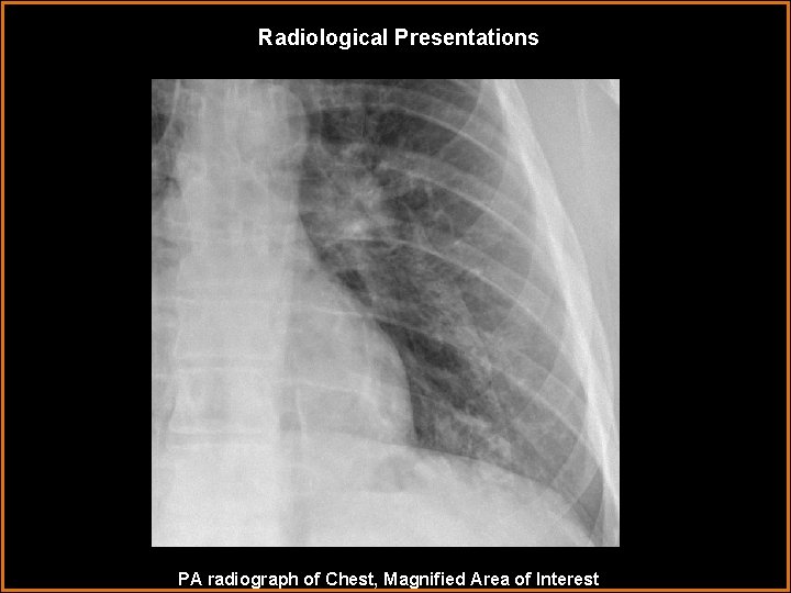 Radiological Presentations PA radiograph of Chest, Magnified Area of Interest 