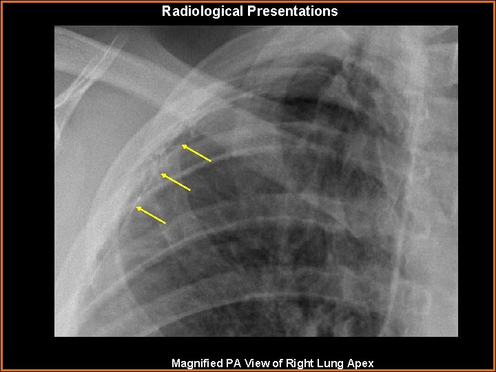 Radiological Presentations Magnified PA View of Right Lung Apex 