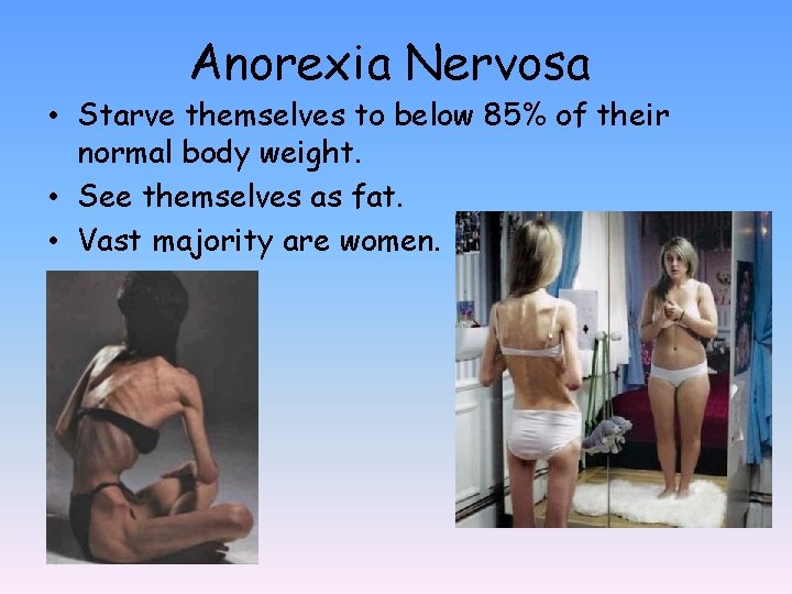 Anorexia Nervosa • Starve themselves to below 85% of their normal body weight. •