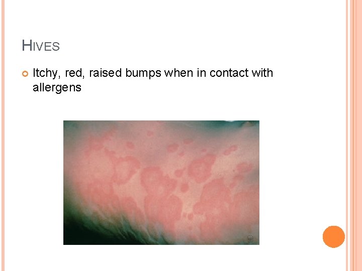HIVES Itchy, red, raised bumps when in contact with allergens 