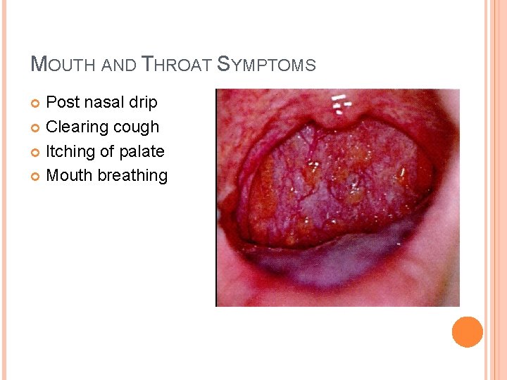 MOUTH AND THROAT SYMPTOMS Post nasal drip Clearing cough Itching of palate Mouth breathing