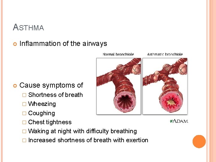 ASTHMA Inflammation of the airways Cause symptoms of � Shortness of breath � Wheezing