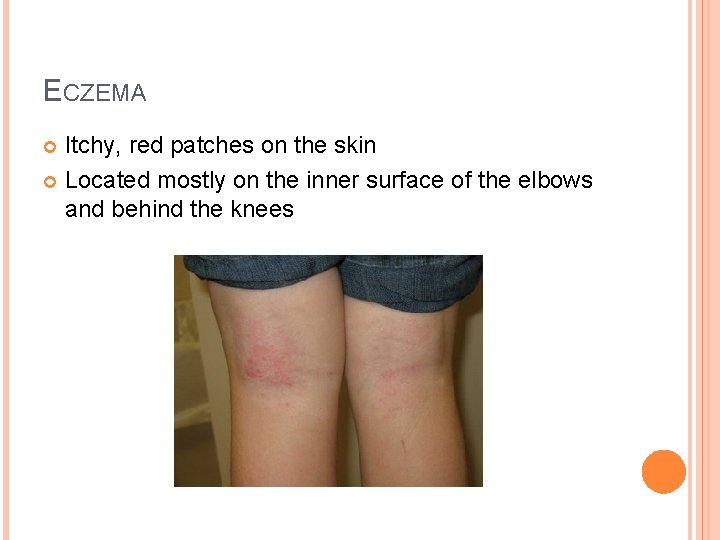 ECZEMA Itchy, red patches on the skin Located mostly on the inner surface of