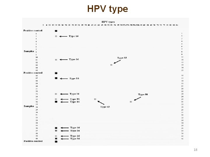 HPV type 18 