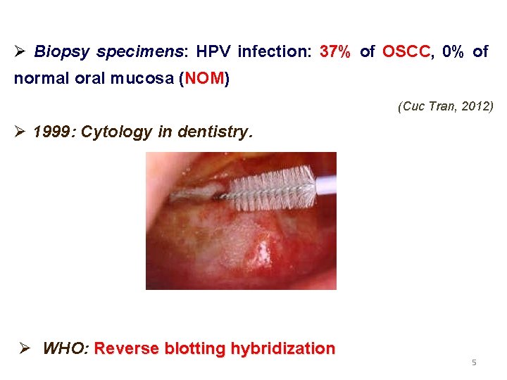 Ø Biopsy specimens: HPV infection: 37% of OSCC, 0% of normal oral mucosa (NOM)