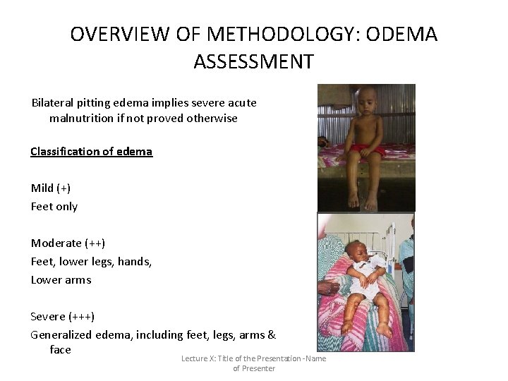 OVERVIEW OF METHODOLOGY: ODEMA ASSESSMENT Bilateral pitting edema implies severe acute malnutrition if not OVERVIEW OF METHODOLOGY: ODEMA ASSESSMENT Bilateral pitting edema implies severe acute malnutrition if not