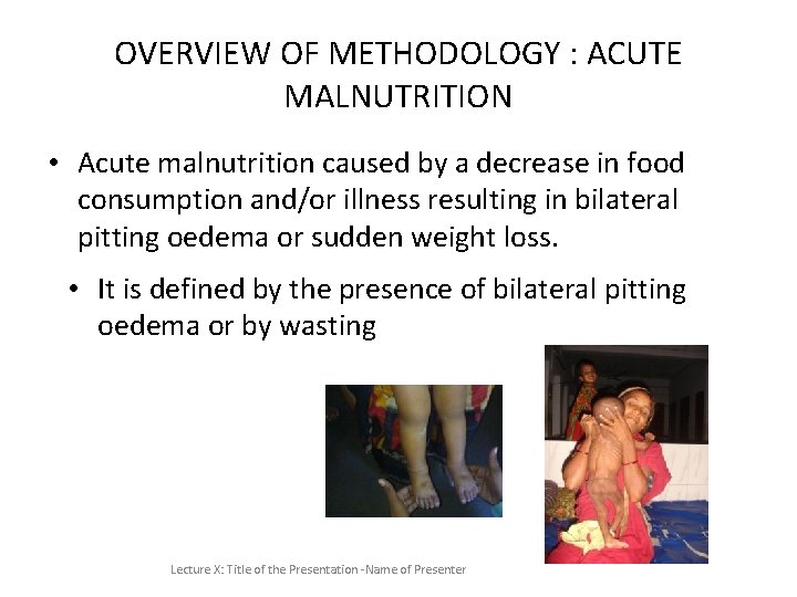 OVERVIEW OF METHODOLOGY : ACUTE MALNUTRITION • Acute malnutrition caused by a decrease in OVERVIEW OF METHODOLOGY : ACUTE MALNUTRITION • Acute malnutrition caused by a decrease in