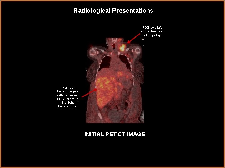 Radiological Presentations FDG avid left supraclavicular adenopathy. Marked hepatomegaly with increased FDG uptake in