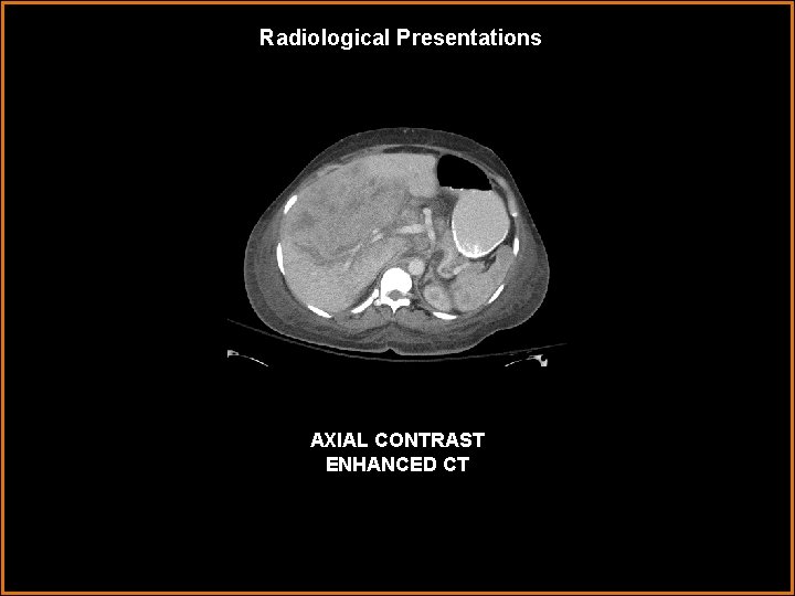 Radiological Presentations AXIAL CONTRAST ENHANCED CT 