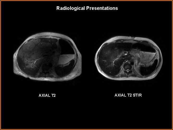 Radiological Presentations AXIAL T 2 STIR 