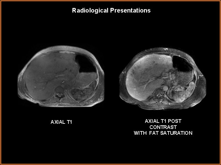 Radiological Presentations AXIAL T 1 POST CONTRAST WITH FAT SATURATION 