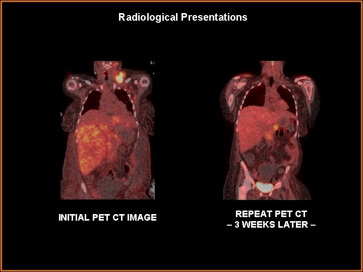 Radiological Presentations INITIAL PET CT IMAGE REPEAT PET CT – 3 WEEKS LATER –