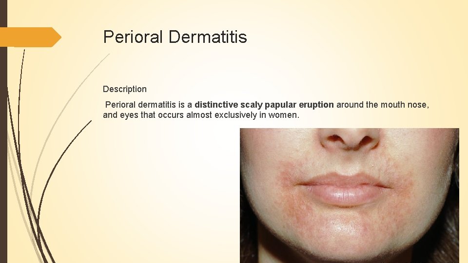 Perioral Dermatitis Description Perioral dermatitis is a distinctive scaly papular eruption around the mouth