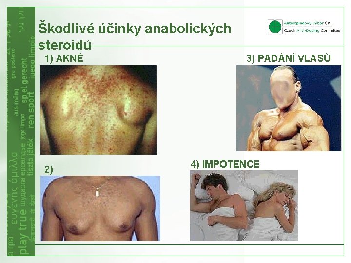 Škodlivé účinky anabolických steroidů 1) AKNÉ 2) GYNEKOMASTIE 3) PADÁNÍ VLASŮ 4) IMPOTENCE 