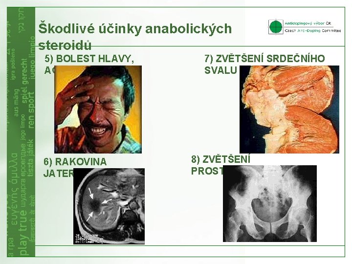 Škodlivé účinky anabolických steroidů 5) BOLEST HLAVY, AGRESIVITA 6) RAKOVINA JATER 7) ZVĚTŠENÍ SRDEČNÍHO