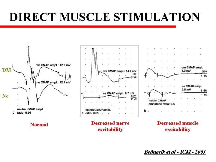 DIRECT MUSCLE STIMULATION DM Ne Normal Decreased nerve excitability Decreased muscle excitability Bednarik et