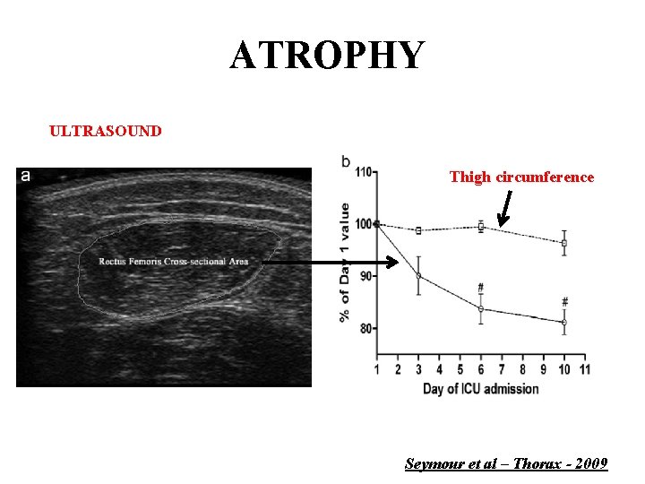 ATROPHY ULTRASOUND Thigh circumference Seymour et al – Thorax - 2009 