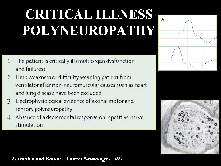 CRITICAL ILLNESS POLYNEUROPATHY Latronico and Bolton – Lancet Neurology - 2011 