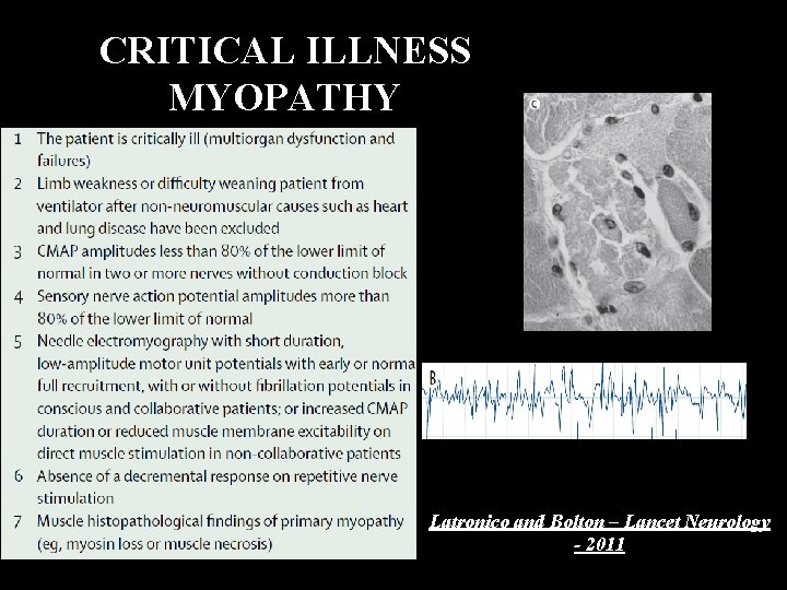 CRITICAL ILLNESS MYOPATHY Latronico and Bolton – Lancet Neurology - 2011 