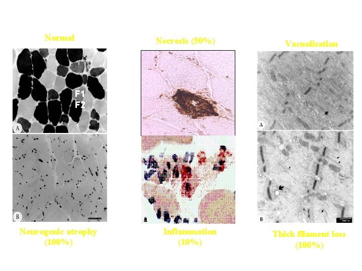 HISTOLOGY Normal Necrosis (50%) Vacuolisation F 1 F 2 Neurogenic atrophy (100%) Inflammation (10%)
