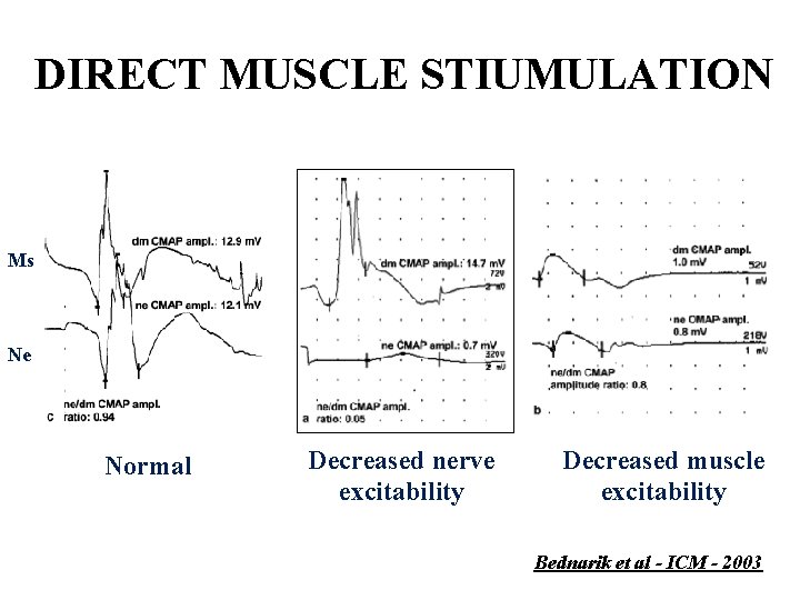 DIRECT MUSCLE STIUMULATION Ms Ne Normal Decreased nerve excitability Decreased muscle excitability Bednarik et
