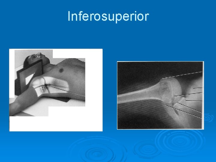 Inferosuperior 