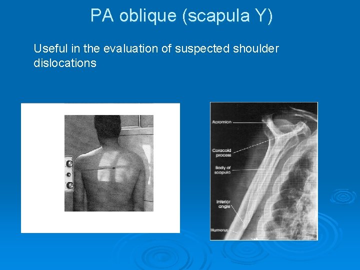 PA oblique (scapula Y) Useful in the evaluation of suspected shoulder dislocations 