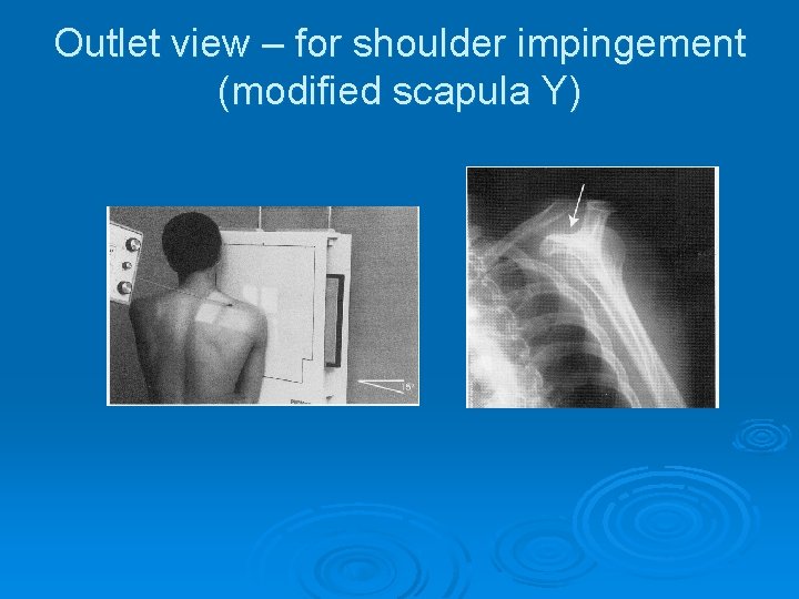 Outlet view – for shoulder impingement (modified scapula Y) 