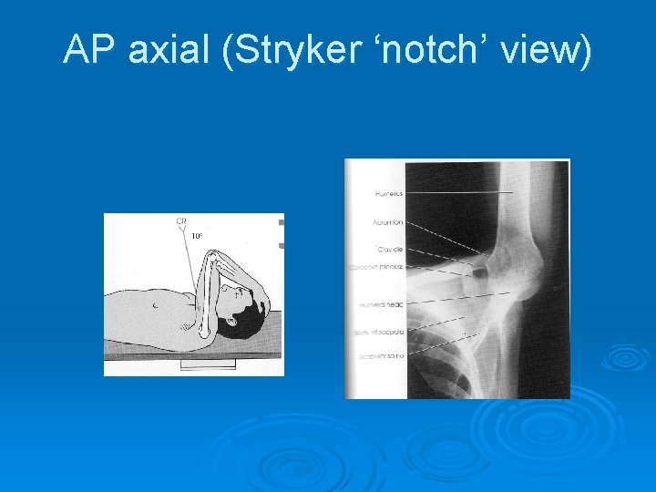 AP axial (Stryker ‘notch’ view) 