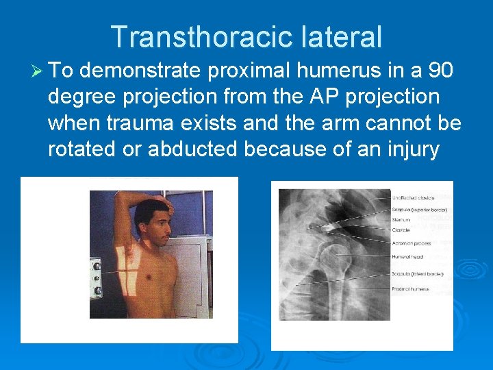 Transthoracic lateral Ø To demonstrate proximal humerus in a 90 degree projection from the