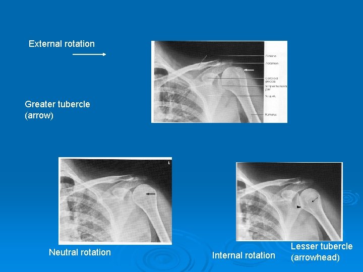 External rotation Greater tubercle (arrow) Neutral rotation Internal rotation Lesser tubercle (arrowhead) 