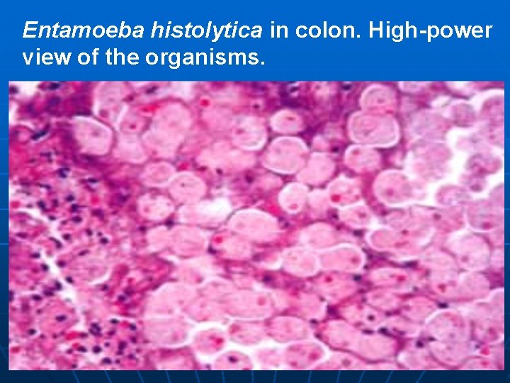 Entamoeba histolytica in colon. High-power view of the organisms. 