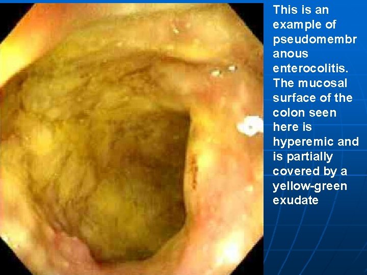 This is an example of pseudomembr anous enterocolitis. The mucosal surface of the colon