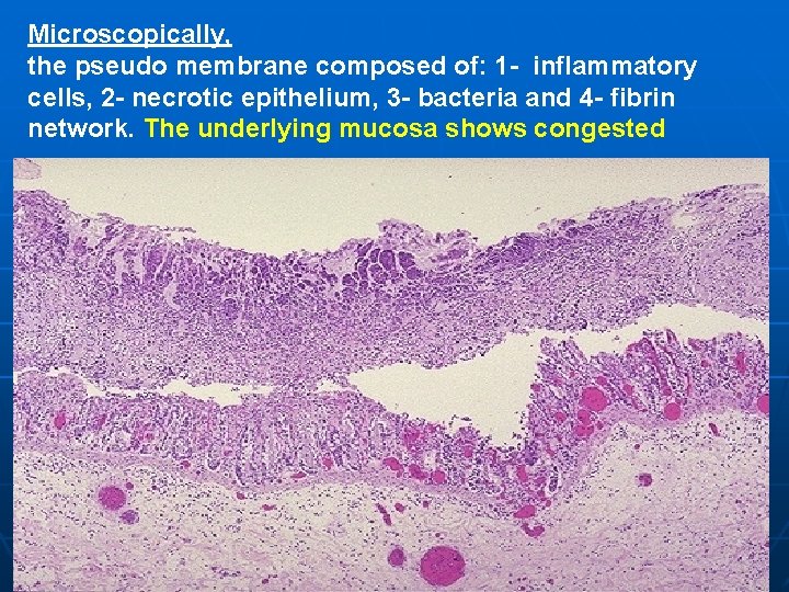 Microscopically, the pseudo membrane composed of: 1 - inflammatory cells, 2 - necrotic epithelium,