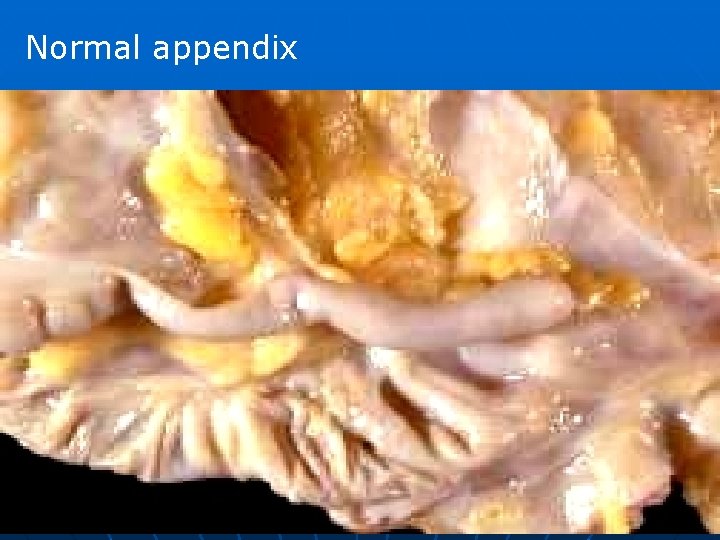Normal appendix 