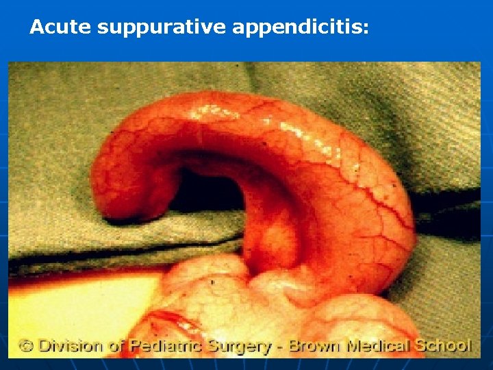 Acute suppurative appendicitis: 