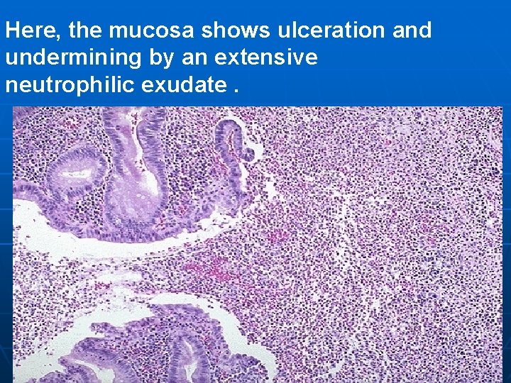 Here, the mucosa shows ulceration and undermining by an extensive neutrophilic exudate. 