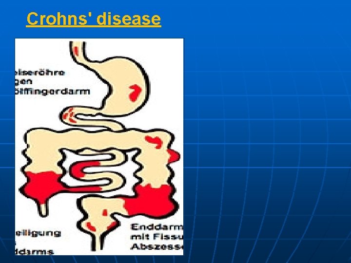 Crohns' disease 