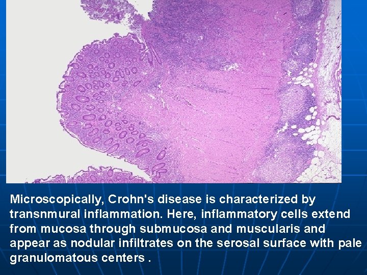 Microscopically, Crohn's disease is characterized by transnmural inflammation. Here, inflammatory cells extend from mucosa