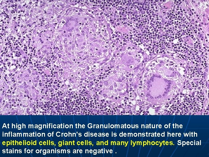 At high magnification the Granulomatous nature of the inflammation of Crohn's disease is demonstrated