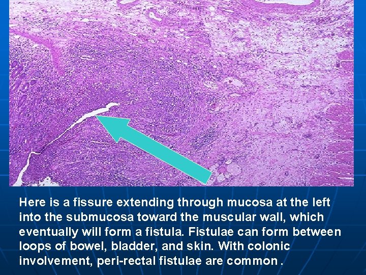 Here is a fissure extending through mucosa at the left into the submucosa toward