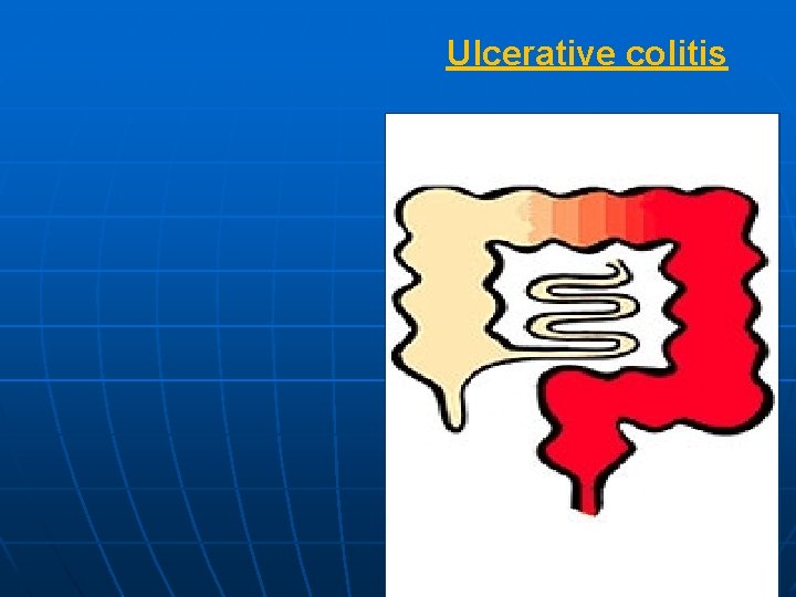 Ulcerative colitis 